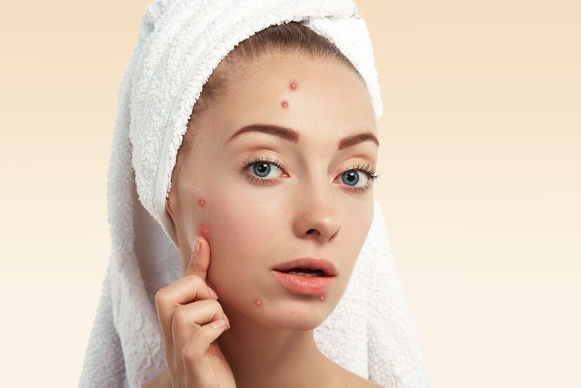 closeup-young-woman-with-towel-head-pimples-face_273609-14431